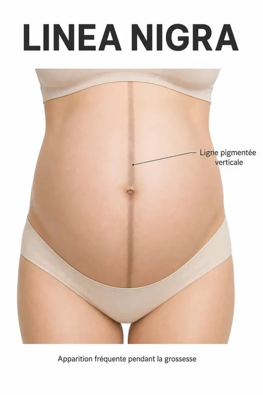 Schéma anatomique montrant la linea nigra sur le ventre d'une femme enceinte pour illustrer le trait de grossesse.