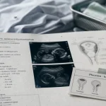 Placenta à l’échographie : localisation, placenta bas et calcifications